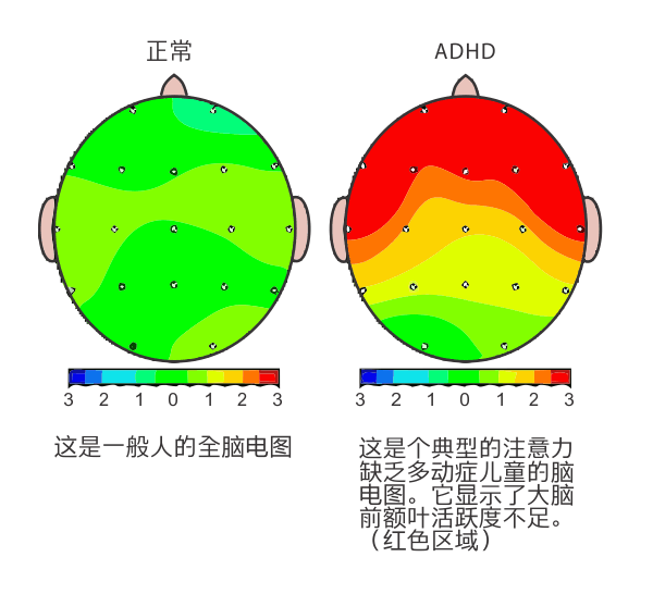 多動(dòng)癥